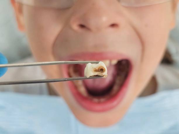 Best Knocked-Out Tooth (Avulsed Tooth) Treatment in Byrnes Mill, MO
